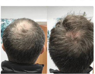 FOLIX™ – Tratamiento avanzado para frenar la caída del cabello y recuperar densidad visible en 90 días