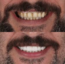 White7 Pro™ – Blanquea tus dientes hasta en 7 días y elimina el amarillo sin dañar el esmalte (SIN FLUOR)