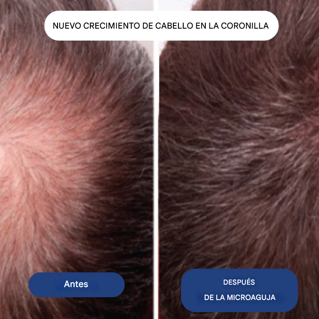 FolixDerm - Bloquea el DHT y activa el crecimeinto del cabello